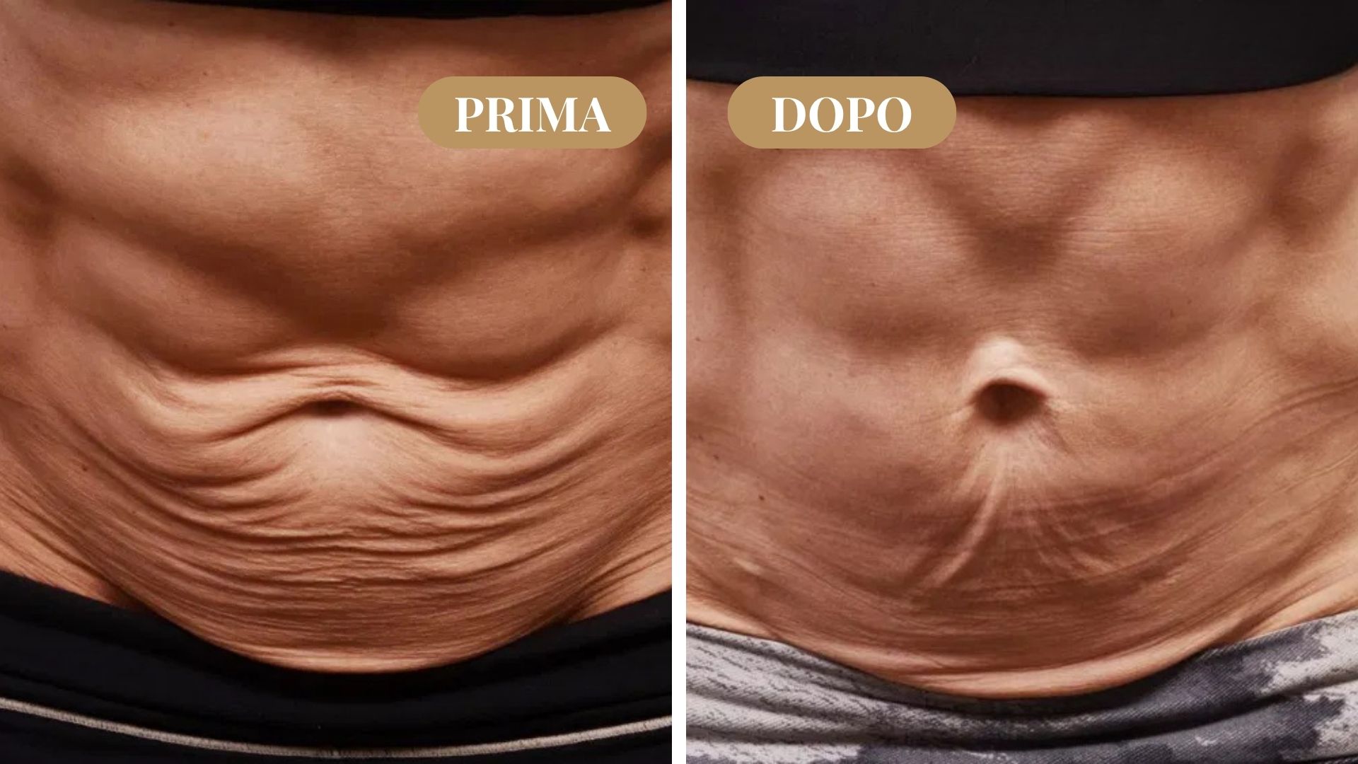Prima e dopo rassodamento addome