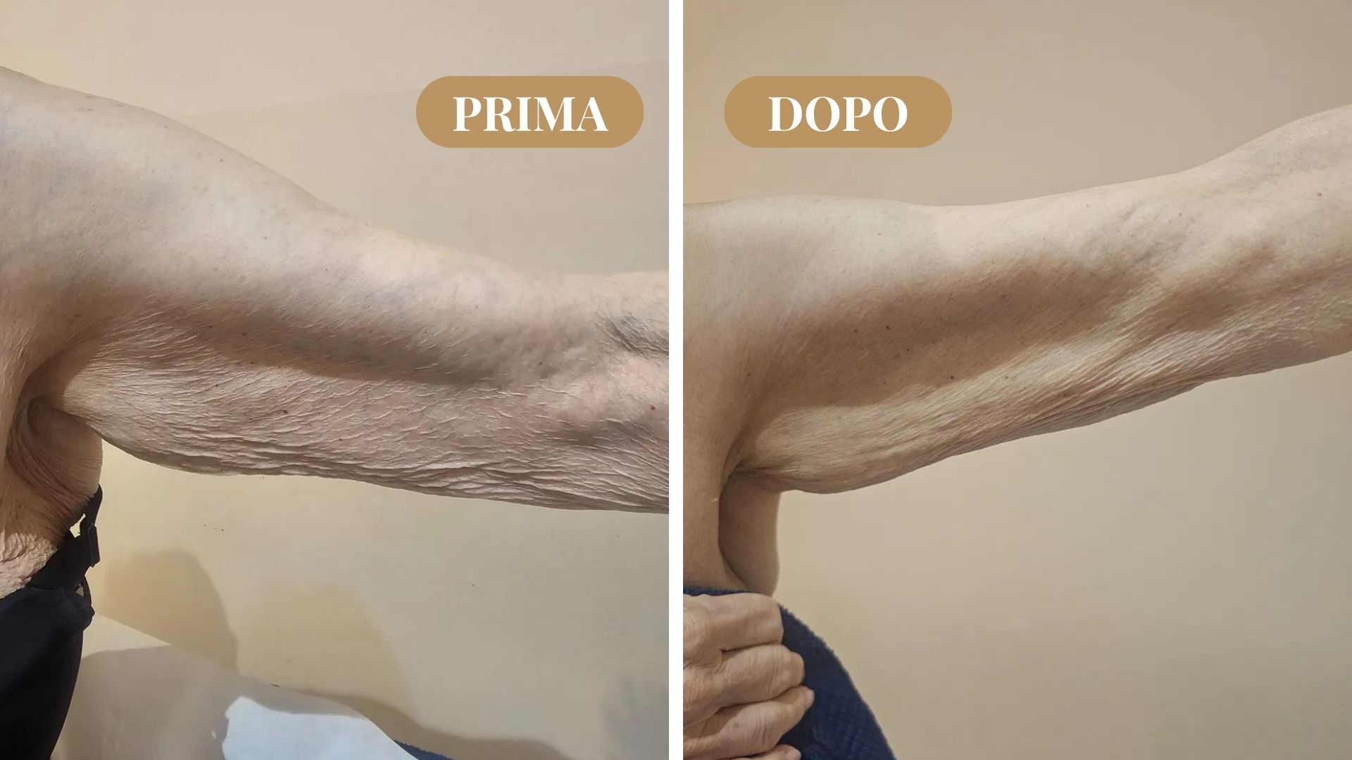 Prima e dopo rimodellamento braccia